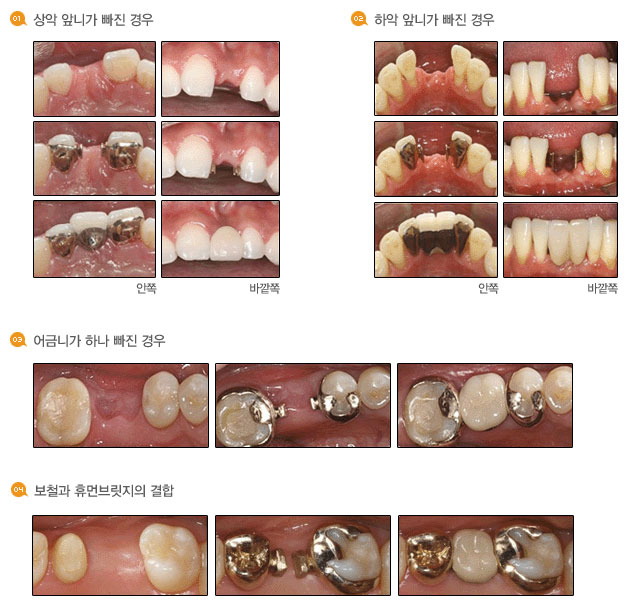 휴먼브릿지의 시술사례