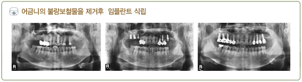 어금니 임플란트