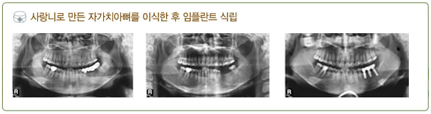 자가치아뼈이식 임플란트