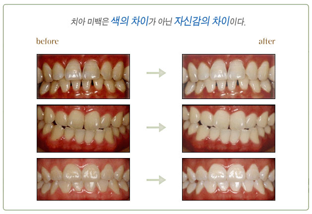 생활치 미백 이미지