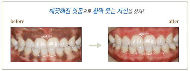 생활치 미백 이미지