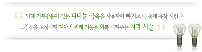 인체 거부반응이 없는 티타늄 금속을 사용하여 뼈 속에 유착시킨 후 보철물을 고정시켜 치아의 원래 기능을 회복시켜주는 치과 시술